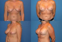 Reductive Augmentation of the Breast Before & After Gallery - Patient 2161520 - Image 1
