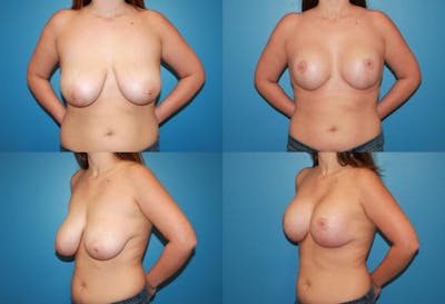 Reductive Augmentation of the Breast Before & After Gallery - Patient 2161522 - Image 1