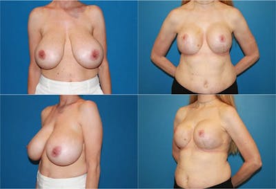 Reductive Augmentation of the Breast Before & After Gallery - Patient 2161533 - Image 1