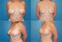 Reductive Augmentation of the Breast Before & After Gallery - Patient 2161538 - Image 1