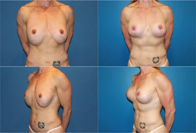 Reductive Augmentation of the Breast Before & After Gallery - Patient 2161539 - Image 1