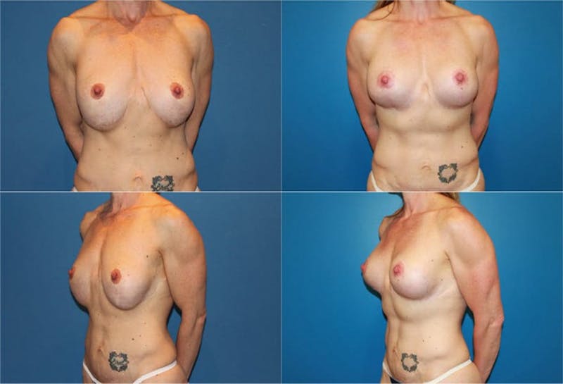 Reductive Augmentation of the Breast Before & After Gallery - Patient 2161539 - Image 1