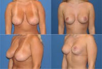 Reductive Augmentation of the Breast Before & After Gallery - Patient 2161541 - Image 1