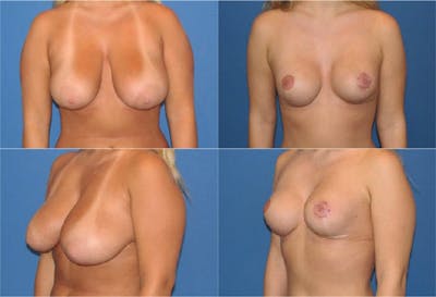 Reductive Augmentation of the Breast Before & After Gallery - Patient 2161541 - Image 1