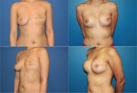 Breast Reconstruction Before & After Gallery - Patient 2161574 - Image 1