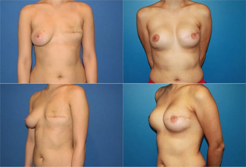 Breast Reconstruction Gallery - Patient 2161574 - Image 1