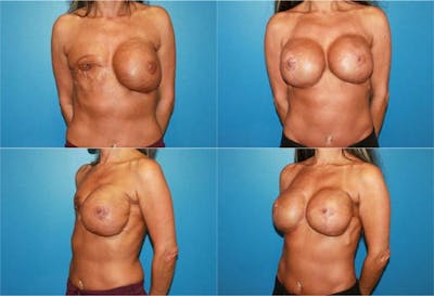 Breast Reconstruction Before & After Gallery - Patient 2161576 - Image 1