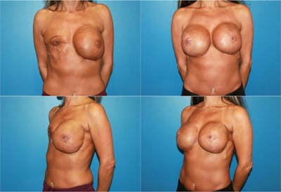 Breast Reconstruction