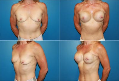 Breast Reconstruction