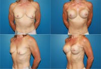 Breast Reconstruction Before & After Gallery - Patient 2161577 - Image 1