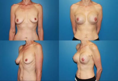 Breast Reconstruction