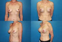 Breast Reconstruction Before & After Gallery - Patient 2161579 - Image 1