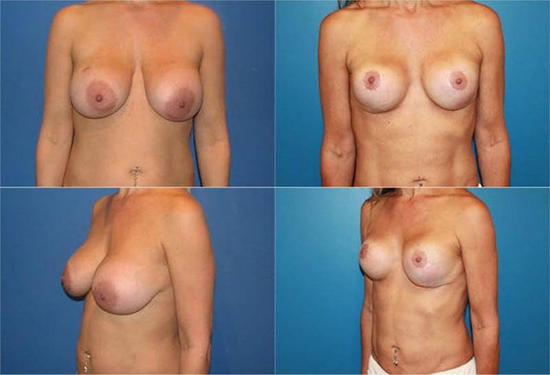 Breast Reconstruction Gallery - Patient 2161585 - Image 1