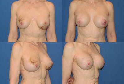 Breast Reconstruction