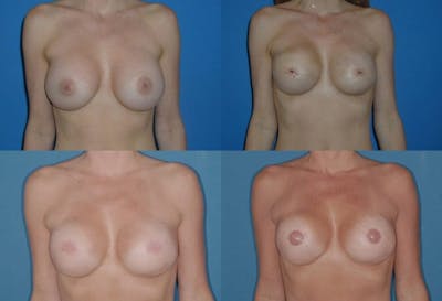 Breast Reconstruction Before & After Gallery - Patient 2161588 - Image 1