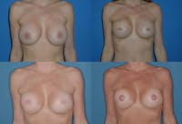 Breast Reconstruction Before & After Gallery - Patient 2161588 - Image 1