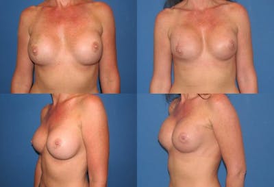 Breast Reconstruction Before & After Gallery - Patient 2161590 - Image 1