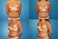 Tubular Breasts Before & After Gallery - Patient 2161610 - Image 1