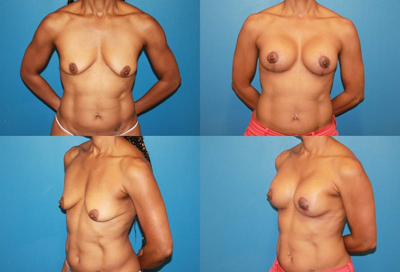Body Building Figure Fitness Breast Augmentation Before & After Gallery - Patient 2161621 - Image 1