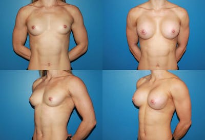Body Building Figure Fitness Breast Augmentation Before & After Gallery - Patient 2161623 - Image 1