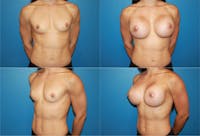 Body Building Figure Fitness Breast Augmentation Before & After Gallery - Patient 2161624 - Image 1