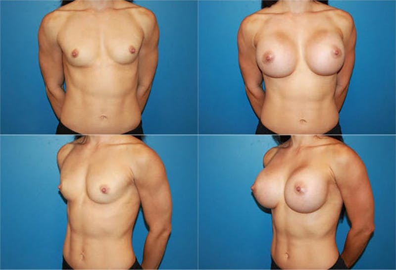 Body Building Figure Fitness Breast Augmentation Before & After Gallery - Patient 2161624 - Image 1