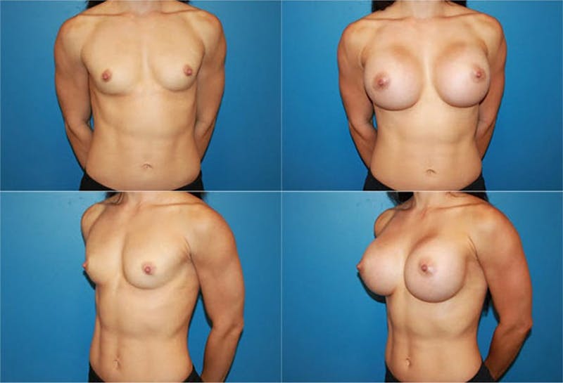 Body Building Figure Fitness Breast Augmentation Gallery - Patient 2161624 - Image 1