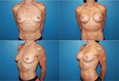 Body Building Figure Fitness Breast Augmentation Before & After Gallery - Patient 2161625 - Image 1