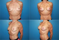 Body Building Figure Fitness Breast Augmentation Before & After Gallery - Patient 2161625 - Image 1