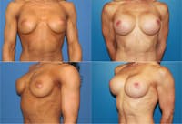 Body Building Figure Fitness Breast Augmentation Before & After Gallery - Patient 2161627 - Image 1