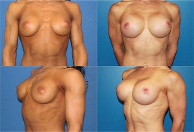 Body Building Figure Fitness Breast Augmentation Before & After Gallery - Patient 2161627 - Image 1