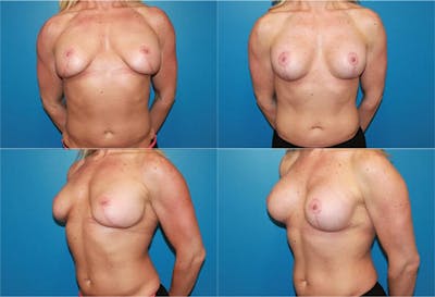 Body Building Figure Fitness Breast Augmentation Before & After Gallery - Patient 2161628 - Image 1