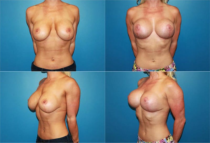 Body Building Figure Fitness Breast Augmentation Before & After Gallery - Patient 2161630 - Image 1