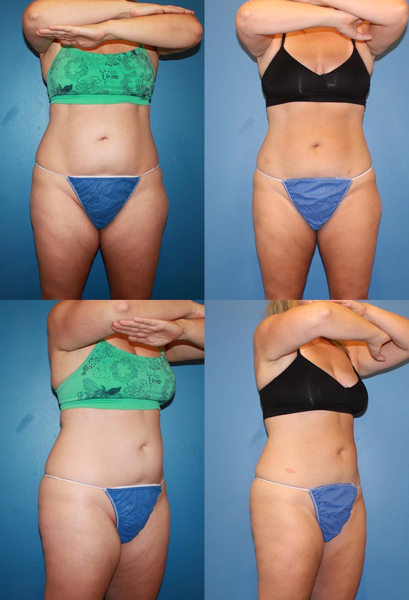 Stomach, Love Handles, Waist & Hips - Coolsculpting Of San Diego