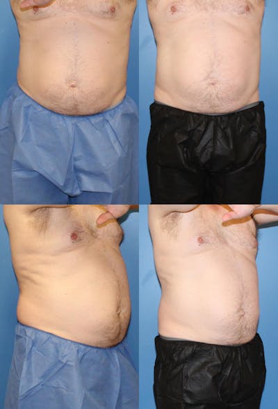 CoolSculpting Elite