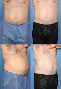 Coolsculpting Before & After Gallery - Patient 2161639 - Image 1