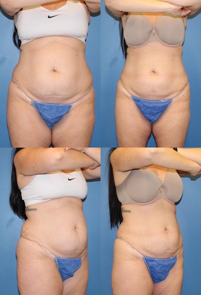 Coolsculpting Elite Before & After Gallery - Patient 2161640 - Image 1