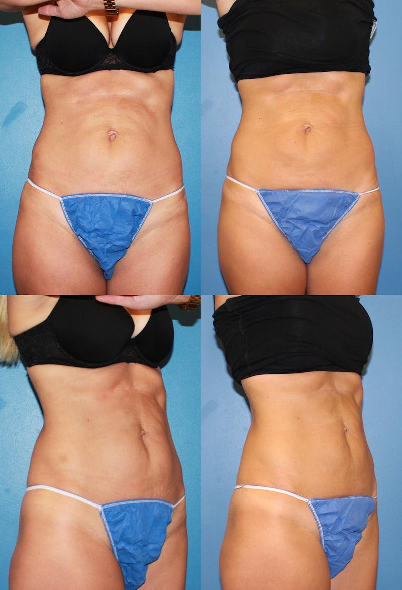 Coolsculpting Before & After Gallery - Patient 2161642 - Image 1