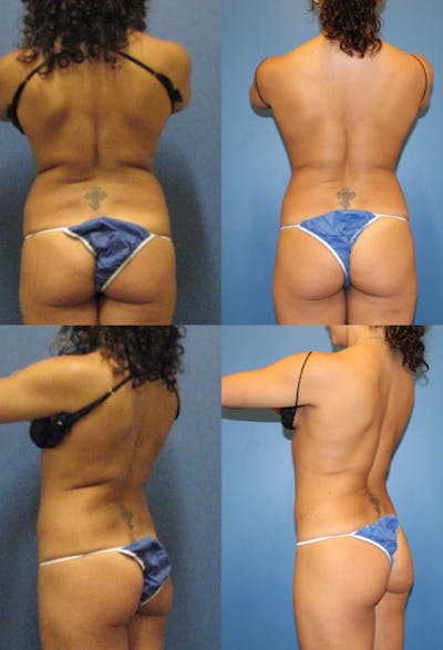 Coolsculpting Gallery - Patient 2161644 - Image 1