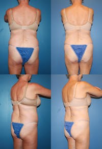 Coolsculpting Gallery - Patient 2161648 - Image 1