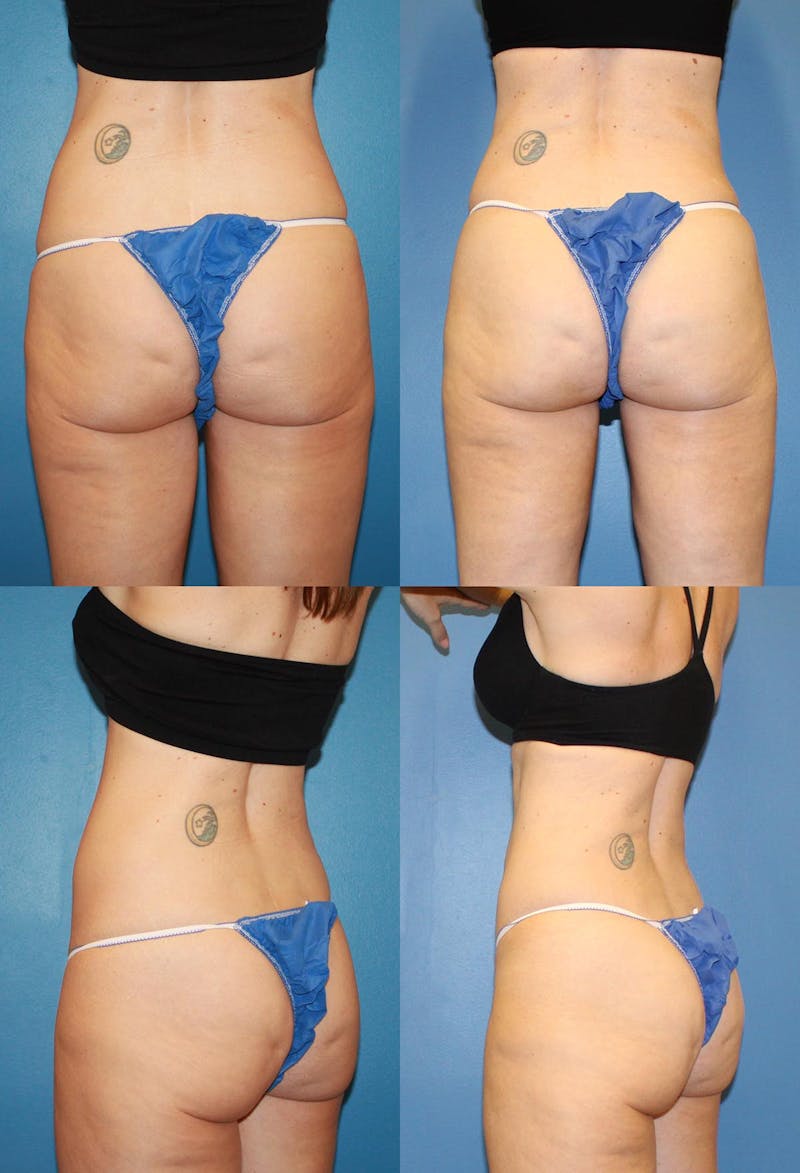 Coolsculpting Elite Before & After Gallery - Patient 2161649 - Image 1