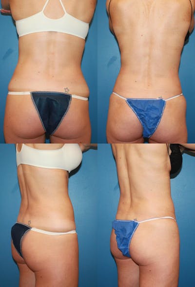 Coolsculpting Elite Before & After Gallery - Patient 2161650 - Image 1