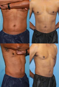 Coolsculpting Elite Before & After Gallery - Patient 2161651 - Image 1
