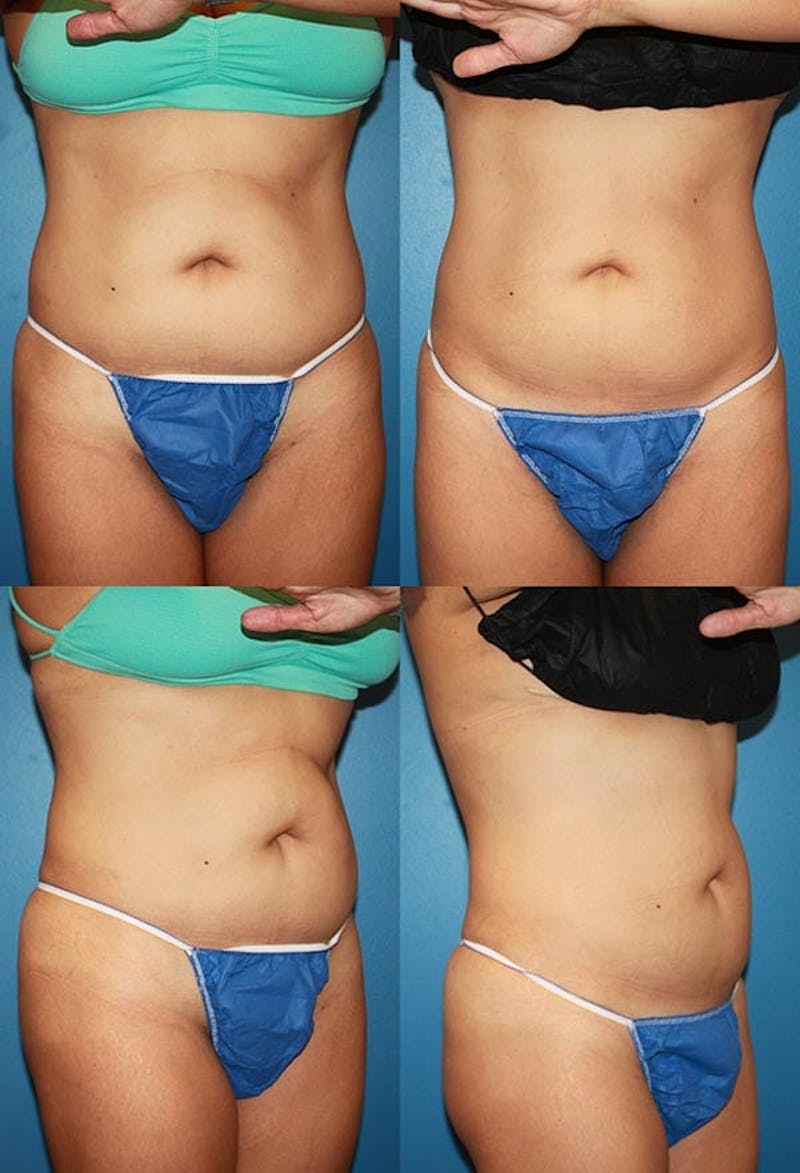 Coolsculpting Gallery - Patient 2161652 - Image 1
