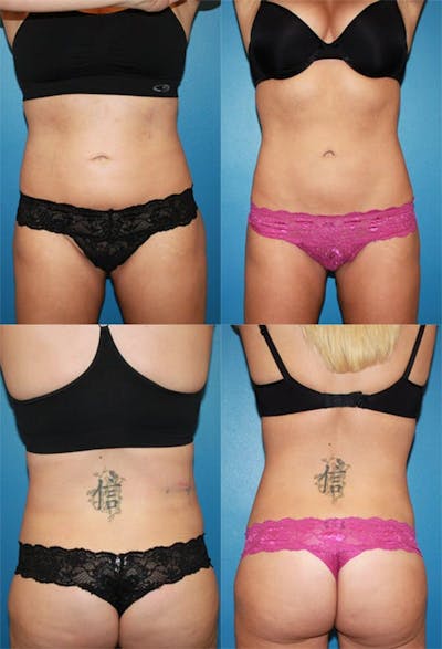Coolsculpting Before & After Gallery - Patient 2161653 - Image 1