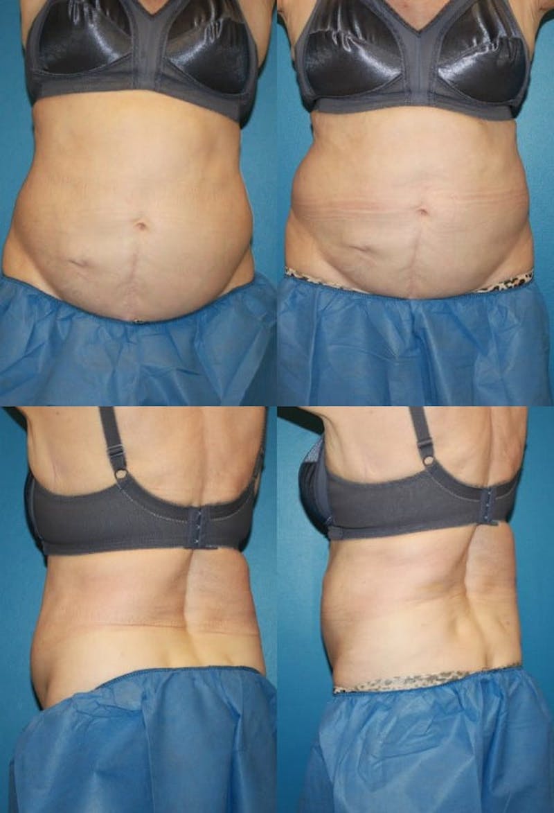 Coolsculpting Before & After Gallery - Patient 2161654 - Image 1