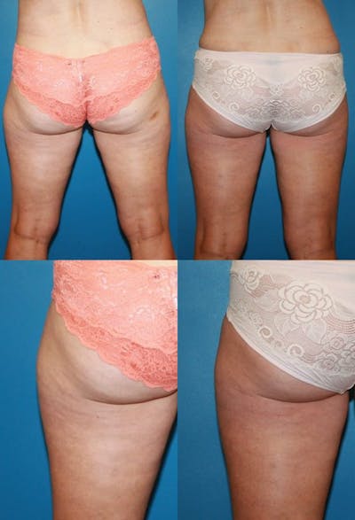 Coolsculpting Elite Before & After Gallery - Patient 2161655 - Image 1