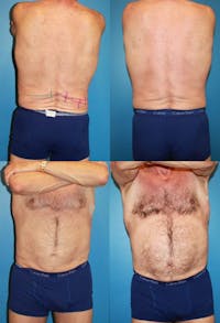 Coolsculpting Before & After Gallery - Patient 2161656 - Image 1