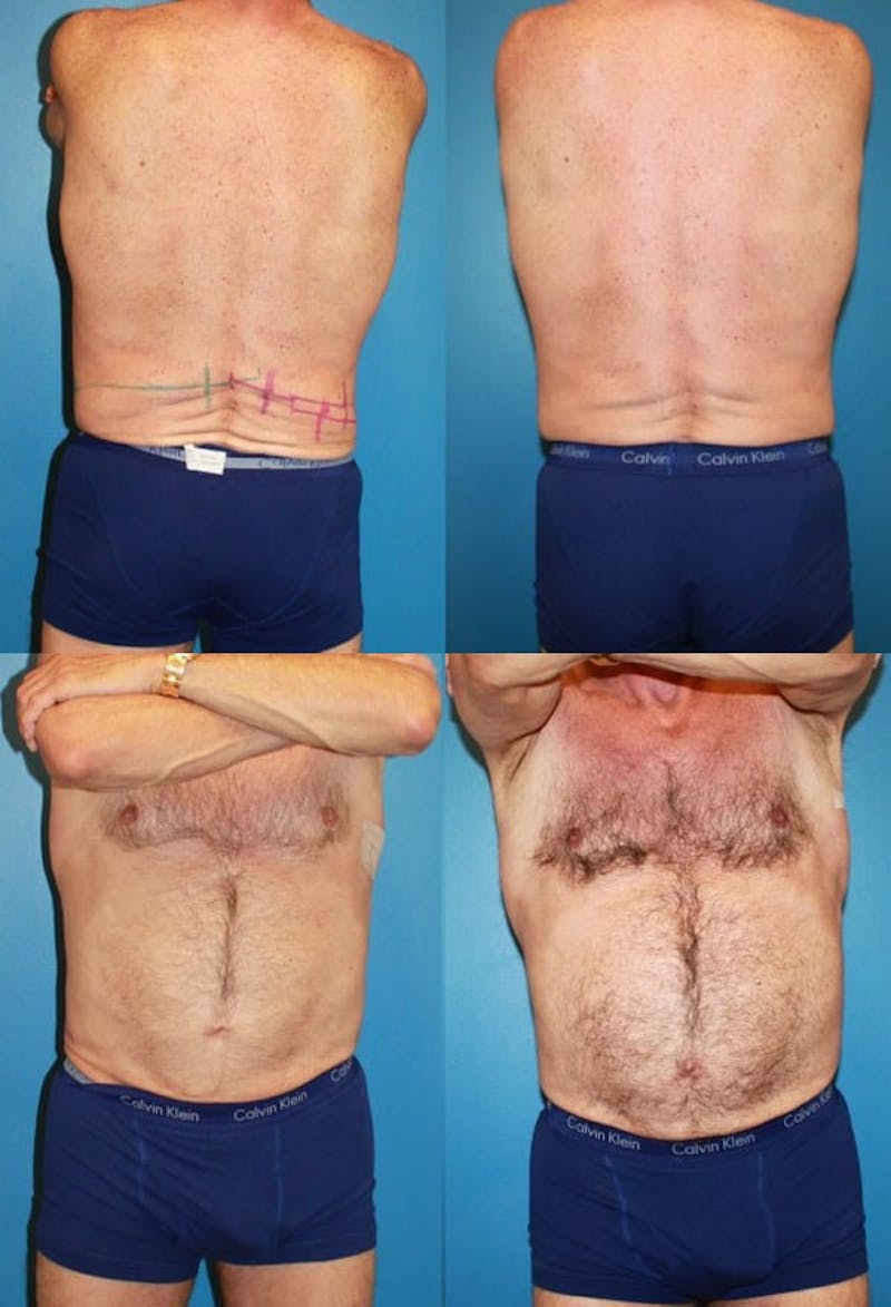 Patient 2161656 | CoolSculpting Before and After | Ranch & Coast Plastic Surgery Patient 2161656 | CoolSculpting Before and After | Ranch & Coast Plastic Surgery