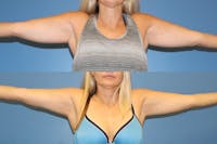 Coolsculpting Before & After Gallery - Patient 2161657 - Image 1